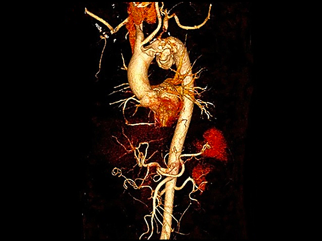 un fragment d'aorta amb unes ramificacions