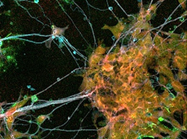 Neurones tant ben formades com mal desenvolupades