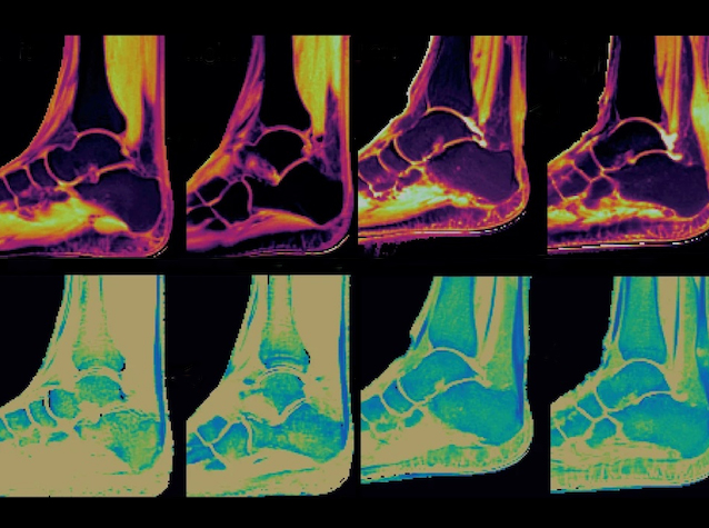 Escàners d'IRM dels tendons d'Aquil·les que mostren alteracions relacionades amb la inflamació