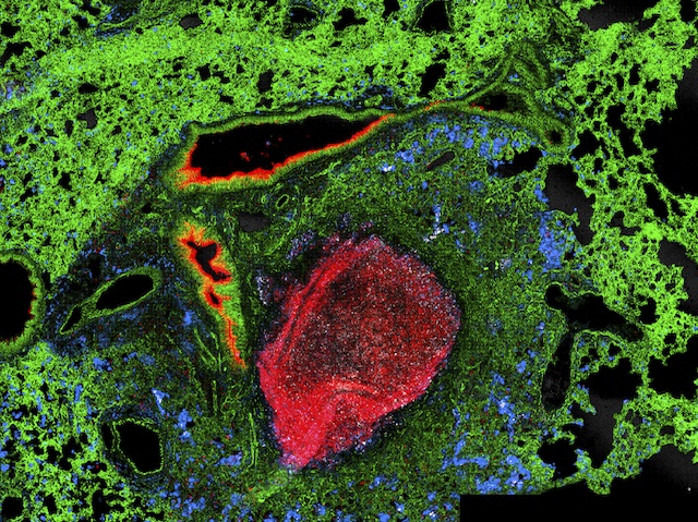 Pulmons infectats amb bactèria TB